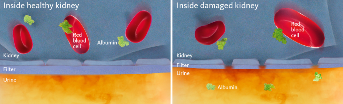 [.SE-se Sweden (swedish)] •	Schematic and simplified view of a healthy and a damaged kidney membrane with the latter illustrating the cause of albuminuria.