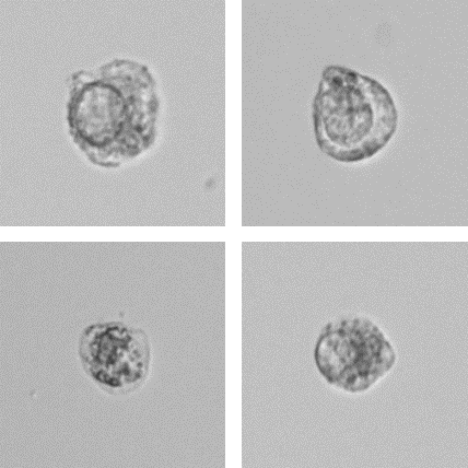 Fig. 3 – Example for atypical cells on the UD-10 digital imaging device