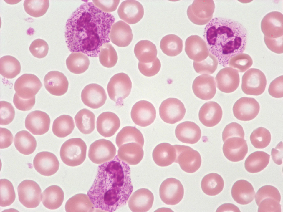 Granulocytes of a patient treated with GCS-F