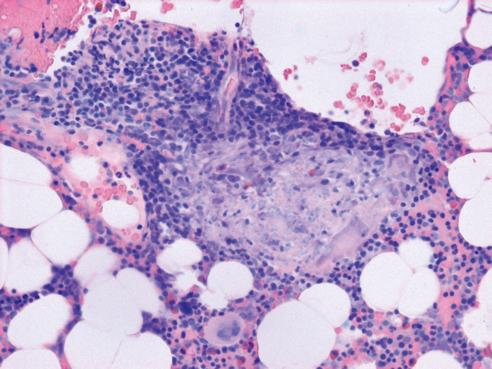Bone marrow histology of a patient with sarcoidosis