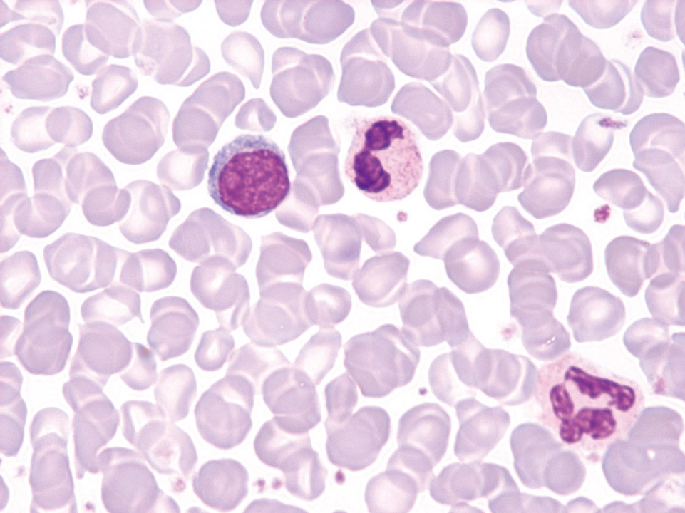 Blood film of a patient with polycythaemia vera (PV)