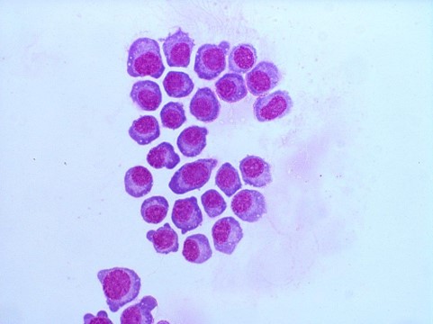 Plasma cells in cytospin of CSF in multiple myeloma